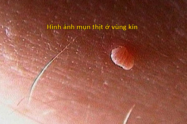 hình ảnh mụn thịt ở vùng kín