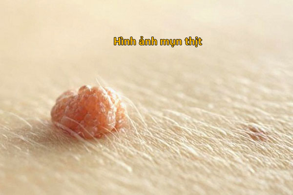 hình ảnh mụn thịt