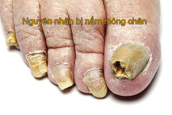 hình ảnh nấm móng chân