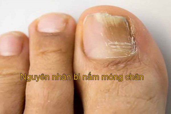 hình ảnh nấm móng chân