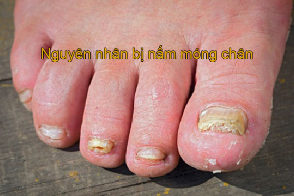 hình ảnh nấm móng chân