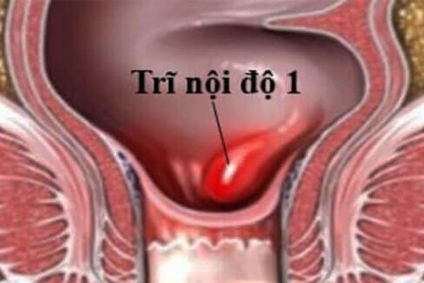 hình ảnh trĩ ngoại độ 1