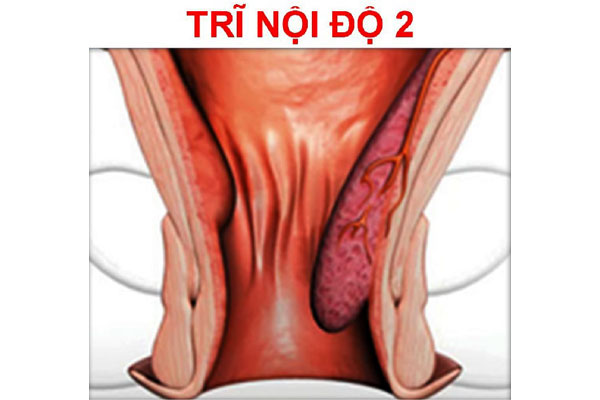 hình ảnh trĩ nội độ 2