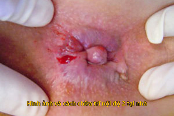 hình ảnh trĩ nội độ 2
