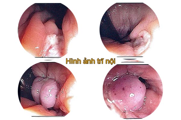 Hình ảnh trĩ nội sau sinh