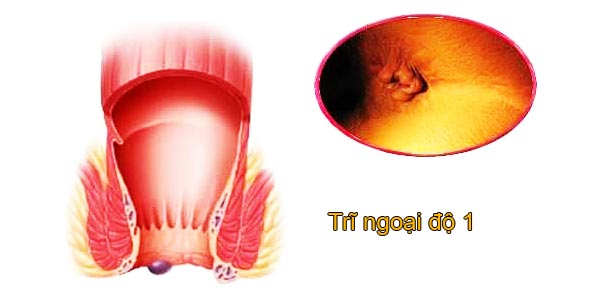 hình ảnh trĩ sau sinh