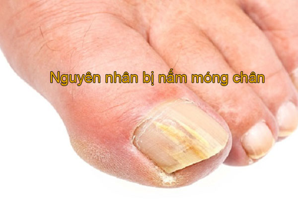 nấm móng chân