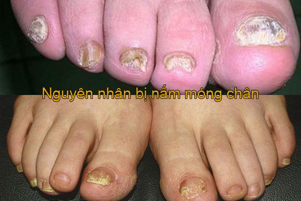 nguyên nhân bị nấm móng chân
