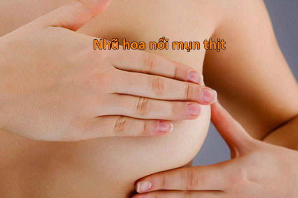 Nhũ hoa nổi mụn thịt
