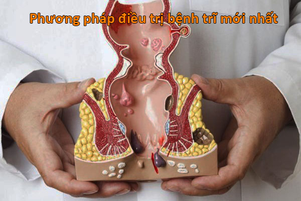 phương pháp điều trị bệnh trĩ mới nhất