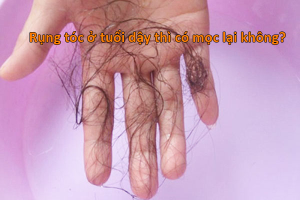 rụng tóc ở tuổi dậy thì