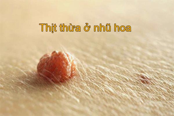 thịt thừa ở nhũ hoa