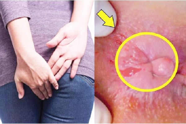 trĩ ngoại độ 2 có tự khỏi không