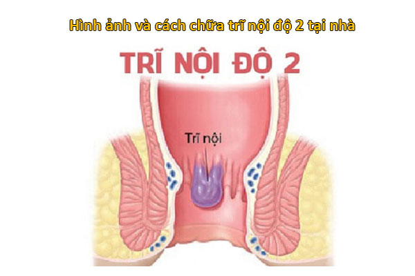 trĩ nội độ 2 có tự khỏi