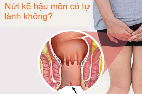 nứt hậu môn bao lâu thì lành