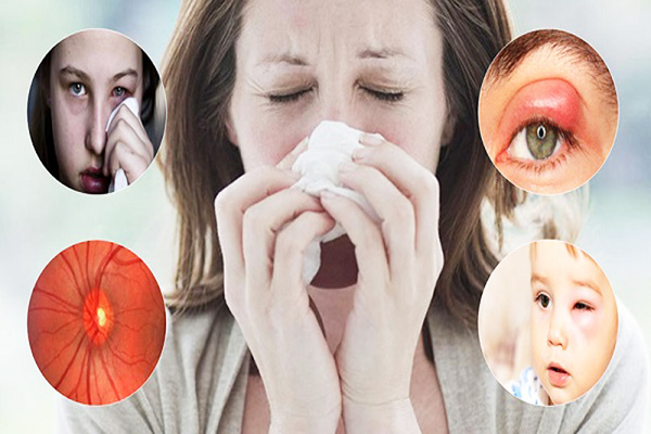 Các biến chứng ở mắt do viêm xoang