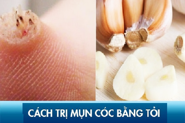 cách trị mụn cóc bằng tỏi