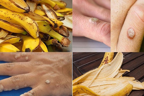 loại bỏ mụn cóc