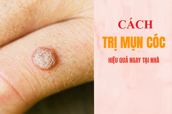 cách trị mụn cóc tại nhà