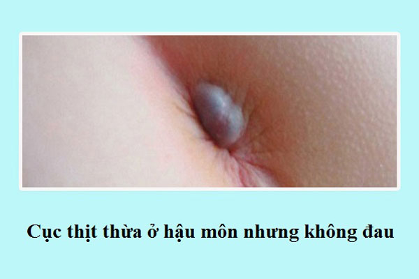 cục thịt thừa ở hậu môn nhưng không đau