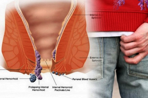 Cục thịt thừa ở hậu môn
