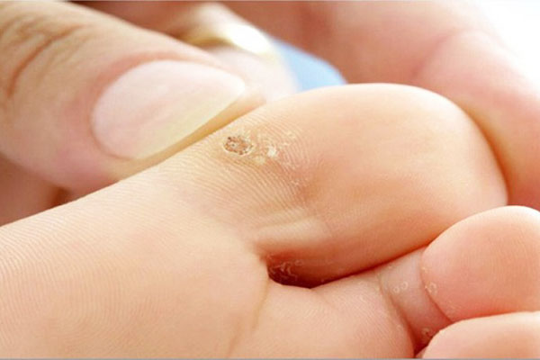 dấu hiệu mụn cóc sắp khỏi