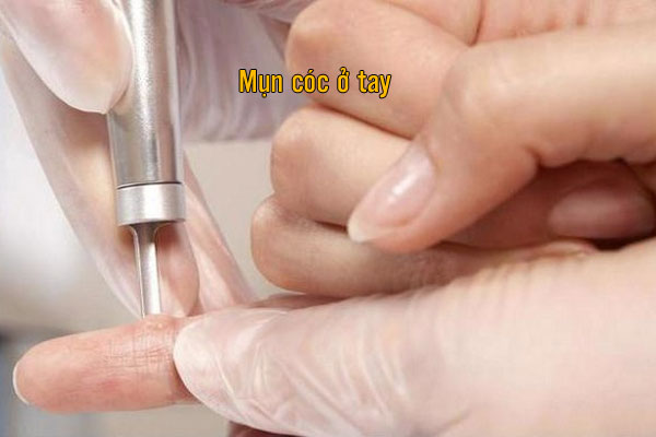 điều trị mụn cóc ở tay