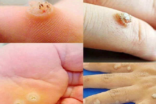 mụn cóc có thể tự biến mất