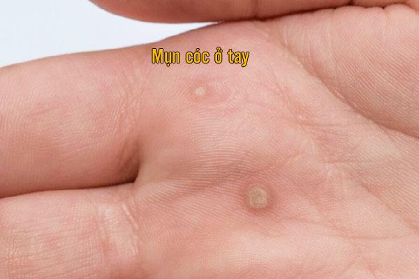 Hình ảnh mụn cóc ở lòng bàn tay