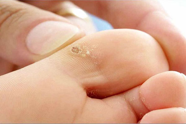 Mụn cóc ở chân