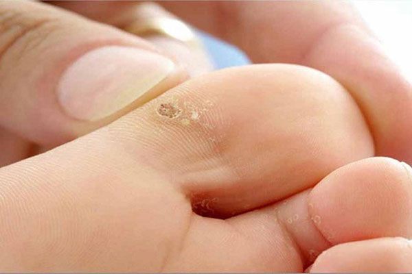 Hình ảnh mụn cóc ở chân