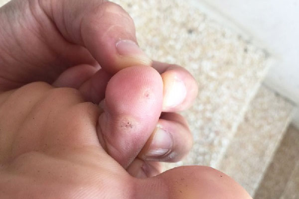 mụn cóc ở ngón chân