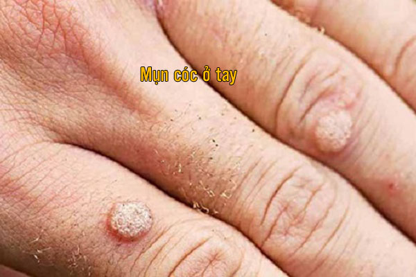Hình ảnh mụn cóc ở ngón tay