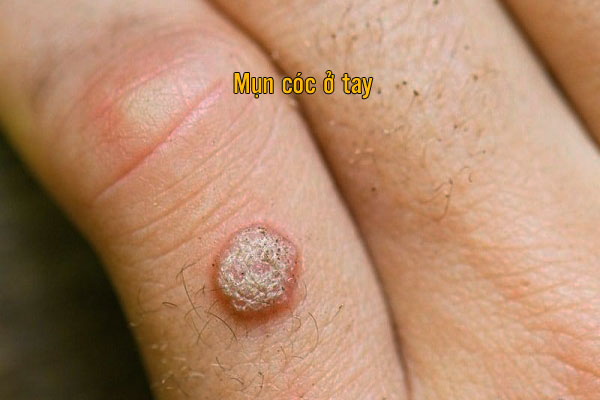 Mụn cóc ở tay