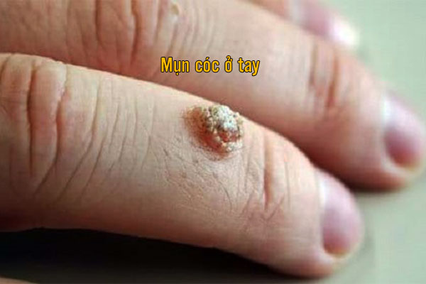 Mụn cóc ở tay