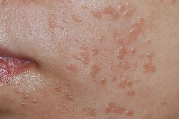 Mụn cóc phẳng