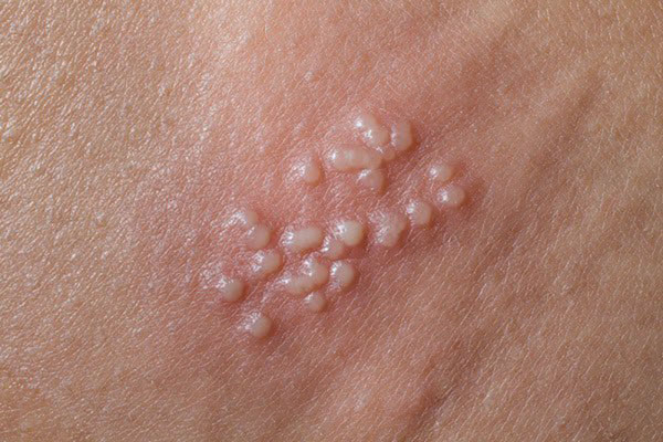 Hình ảnh mụn cóc sinh dục
