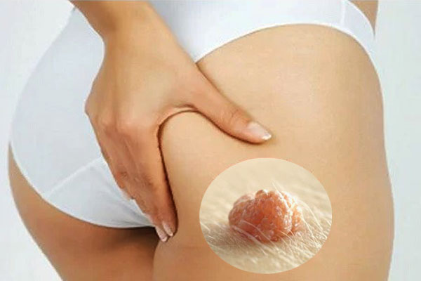 Mụn thịt ở mông