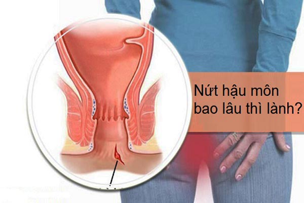 nứt hậu môn bao lâu thì lành