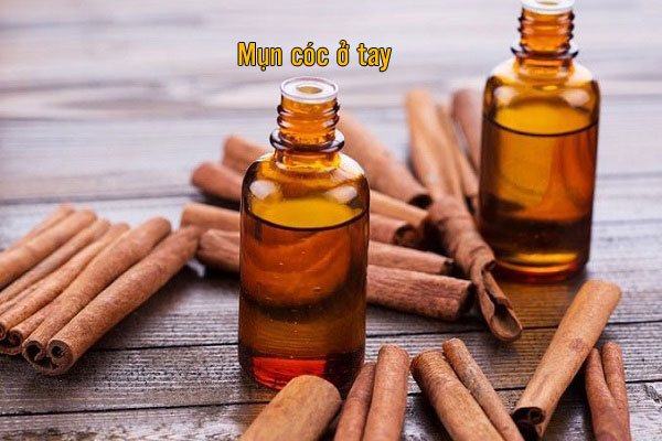 loại bỏ mụn cóc ở tay