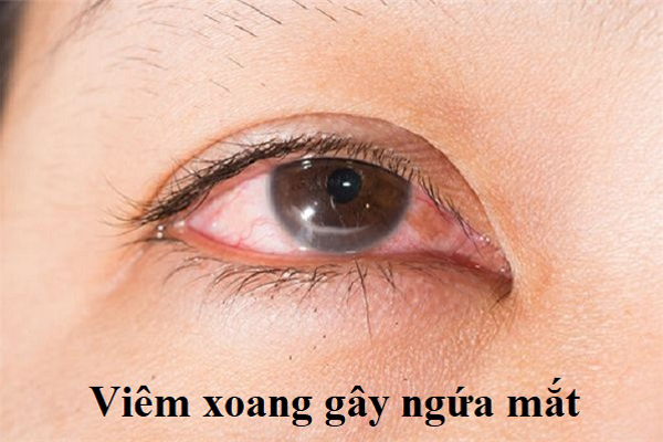 Viêm xoang gây ngứa mắt