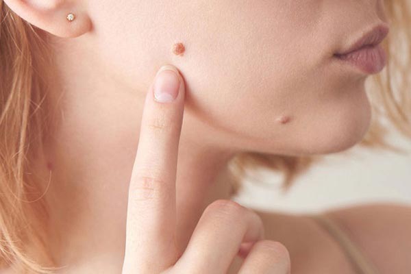Mụn cóc trên mặt