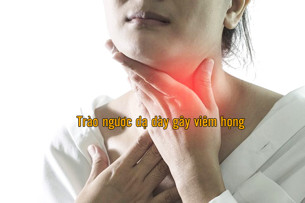 trào ngược dạ dày gây viêm họng