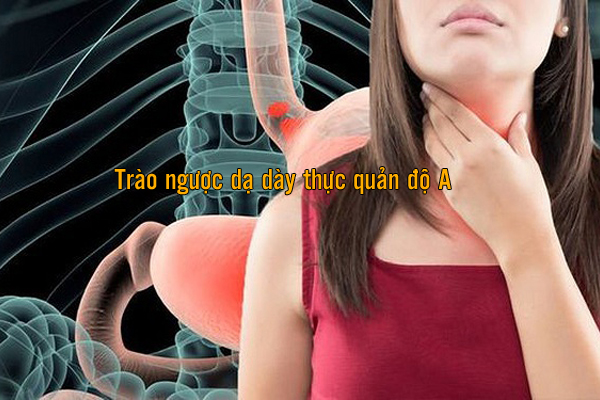Trào ngược dạ dày thực quản độ A