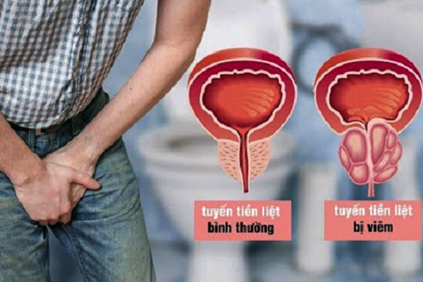đau bụng dưới rốn ở nam