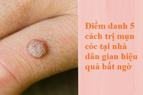 cách trị mụn cóc tại nhà dân gian