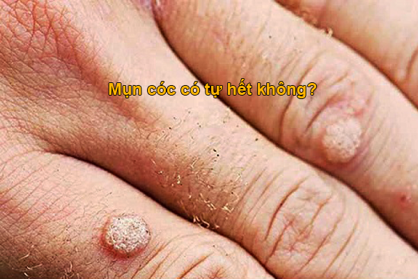 mụn cóc có tự hết không