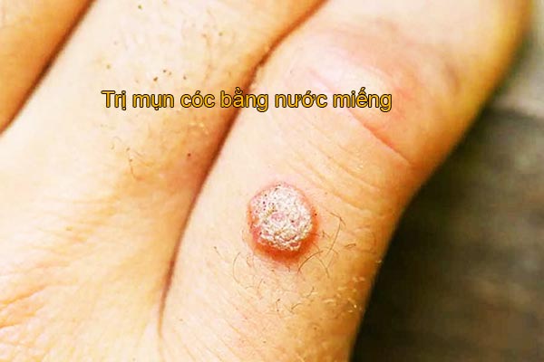 trị mụn cóc