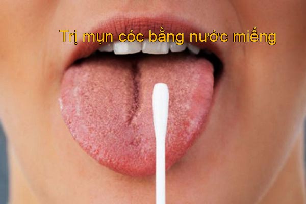 Trị mụn cóc bằng nước miếng