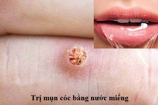 trị mụn cóc bằng nước miếng